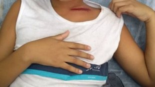 Menino de 11 anos é baleado de raspão dentro da escola no Rio